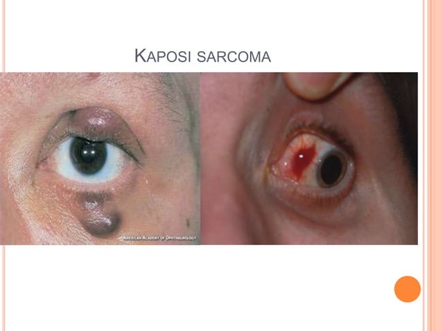 Ocular manifestation of hiv | PPTX | Eye and Vision Conditions ...