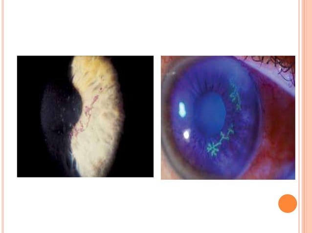 Ocular manifestation of hiv | PPTX | Eye and Vision Conditions ...