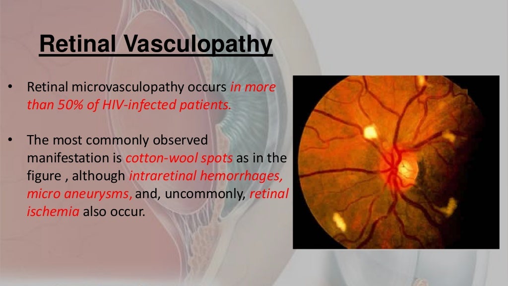 Ocular manifestations of hiv