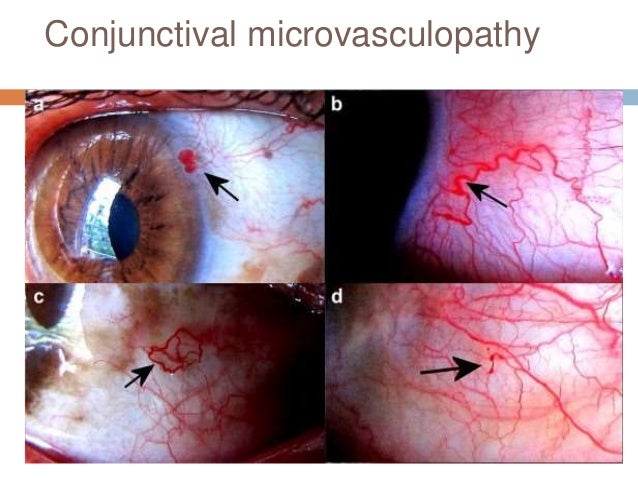 Ocular manifestations of HIV