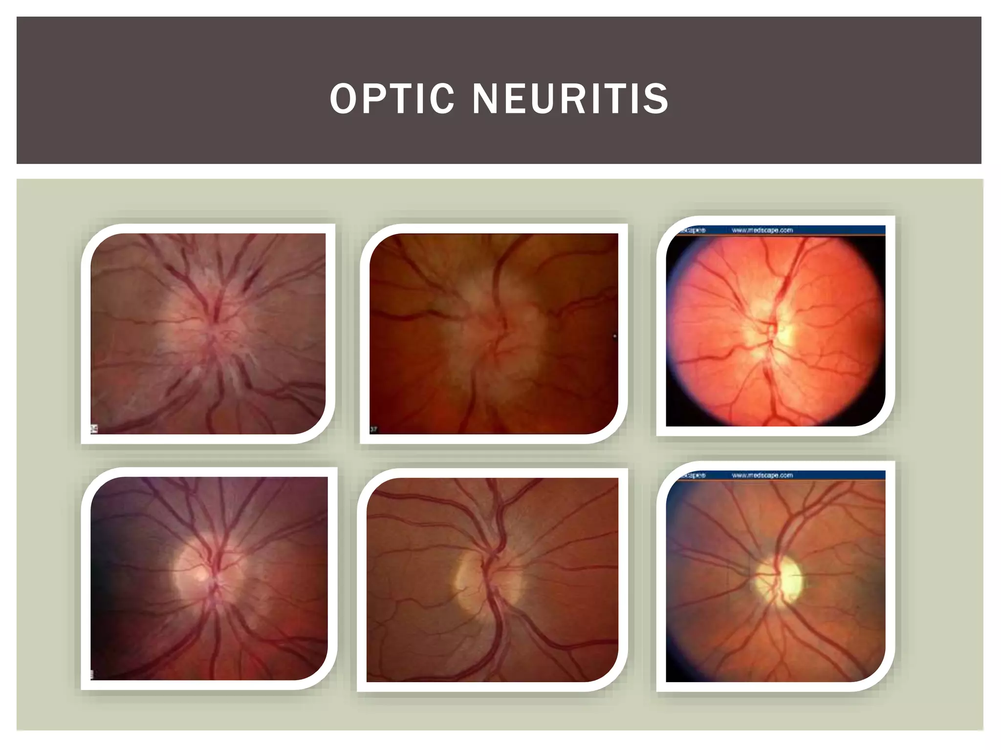 Ocular manifestations of syphilis | PPTX