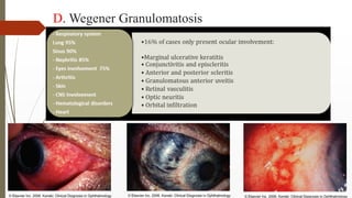 D. Wegener Granulomatosis
 