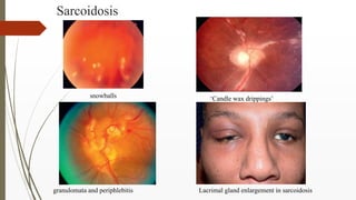 Sarcoidosis
granulomata and periphlebitis
‘Candle wax drippings’snowballs
Lacrimal gland enlargement in sarcoidosis
 