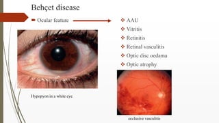 Behçet disease
 Ocular feature  AAU
 Vitritis
 Retinitis
 Retinal vasculitis
 Optic disc oedama
 Optic atrophy
Hypo...