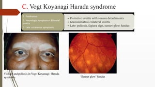 C. Vogt Koyanagi Harada syndrome
Vitiligo and poliosis in Vogt–Koyanagi–Harada
syndrome ‘Sunset glow’ fundus
 