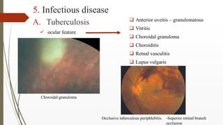 5. Infectious disease
A. Tuberculosis
 ocular feature
 Anterior uveitis – granulomatous
 Vitritis
 Choroidal granuloma...