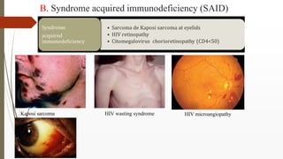 B. Syndrome acquired immunodeficiency (SAID)
Kaposi sarcoma HIV wasting syndrome HIV microangiopathy
 