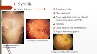C. Syphilis
 Ocular features  Anterior uveitis
 Chorioretinitis
 Acute syphilitic posterior placoid
chorioretinopathy ...