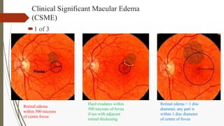 Clinical Significant Macular Edema
(CSME)
1 of 3
Retinal edema
within 500 microns
of centre fovea
Hard exudates within
50...