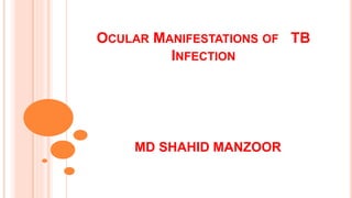 OCULAR MANIFESTATIONS OF TB
INFECTION
MD SHAHID MANZOOR
 
