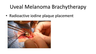 Uveal Melanoma Brachytherapy
• Radioactive iodine plaque placement
 