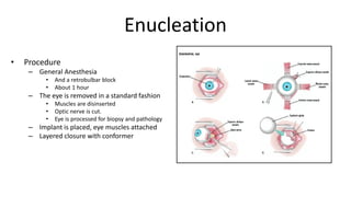 Enucleation
• Procedure
– General Anesthesia
• And a retrobulbar block
• About 1 hour
– The eye is removed in a standard fashion
• Muscles are disinserted
• Optic nerve is cut.
• Eye is processed for biopsy and pathology
– Implant is placed, eye muscles attached
– Layered closure with conformer
 