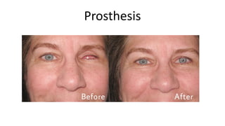 Prosthesis
 