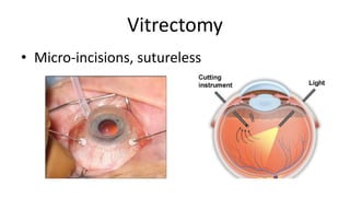Vitrectomy
• Micro-incisions, sutureless
 