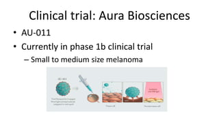 Clinical trial: Aura Biosciences
• AU-011
• Currently in phase 1b clinical trial
– Small to medium size melanoma
 