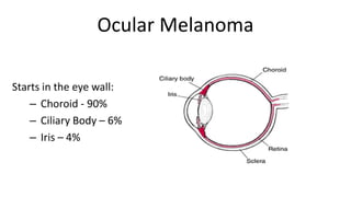 Ocular Melanoma
Starts in the eye wall:
– Choroid - 90%
– Ciliary Body – 6%
– Iris – 4%
 