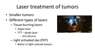 If the tumor is too big…
• Enucleation
– Salvage of the eye is impossible
– The eye may be painful
– The eye may be blind
...