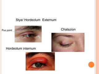 Hordeolo Ocular methods | PPTX