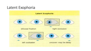 Latent Exophoria
 