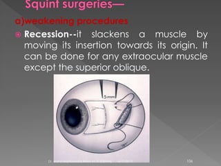 a)weakening procedures
 Recession--it slackens a muscle by
moving its insertion towards its origin. It
can be done for any extraocular muscle
except the superior oblique.
6/17/2015Dr. Mohd Najmussadiq Khan, M. S. (Ophth) 106
 