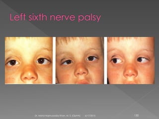 6/17/2015Dr. Mohd Najmussadiq Khan, M. S. (Ophth) 130
 