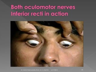 6/17/2015Dr. Mohd Najmussadiq Khan, M. S. (Ophth) 31
 