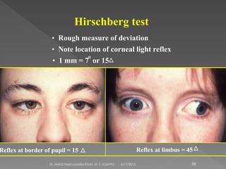 Hirschberg test
• Rough measure of deviation
• Note location of corneal light reflex
Reflex at border of pupil = 15 Reflex at limbus = 45
• 1 mm = 7 or 15
6/17/2015Dr. Mohd Najmussadiq Khan, M. S. (Ophth) 58
 