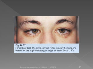 6/17/2015Dr. Mohd Najmussadiq Khan, M. S. (Ophth) 59
 
