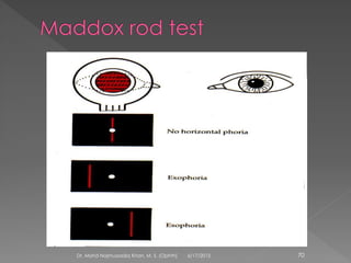 6/17/2015Dr. Mohd Najmussadiq Khan, M. S. (Ophth) 70
 