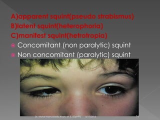 A)apparent squint(pseudo strabismus)
B)latent squint(heterophoria)
C)manifest squint(hetrotropia)
 Concomitant (non paralytic) squint
 Non concomitant (paralytic) squint
6/17/2015Dr. Mohd Najmussadiq Khan, M. S. (Ophth) 74
 