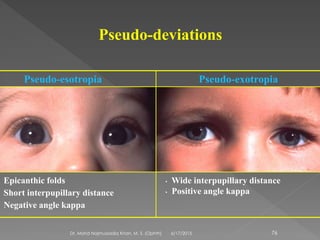 Pseudo-deviations
Pseudo-esotropia
Epicanthic folds
Short interpupillary distance
Negative angle kappa
Pseudo-exotropia
• Wide interpupillary distance
• Positive angle kappa
6/17/2015Dr. Mohd Najmussadiq Khan, M. S. (Ophth) 76
 