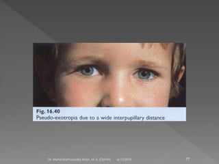6/17/2015Dr. Mohd Najmussadiq Khan, M. S. (Ophth) 77
 