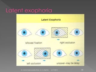 6/17/2015Dr. Mohd Najmussadiq Khan, M. S. (Ophth) 80
 
