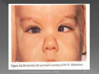 6/17/2015Dr. Mohd Najmussadiq Khan, M. S. (Ophth) 85
 