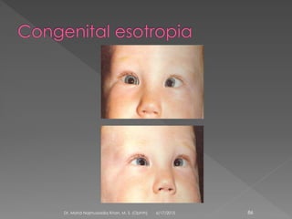 6/17/2015Dr. Mohd Najmussadiq Khan, M. S. (Ophth) 86
 