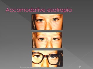 6/17/2015Dr. Mohd Najmussadiq Khan, M. S. (Ophth) 87
 