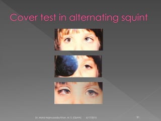 6/17/2015Dr. Mohd Najmussadiq Khan, M. S. (Ophth) 91
 