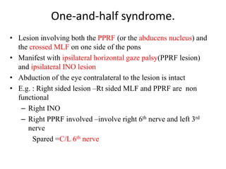 Pons Ino ocular motility disorder wudie.pptx