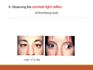 Hirschberg Examples Comprehensive Overview of Ocular Motility, Strabismus, and Amblyopia in ...