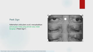Peek Sign
Kelemahan orbicularis oculi, menyebabkan
penutupan mata yang lemah atau tidak
lengkap (“Peek Sign")
O'Hare M, Doughty C. Update on ocular myasthenia gravis. InSeminars in Neurology 2019 Dec (Vol. 39, No. 06, pp. 749-760). Thieme Medical Publishers.
 