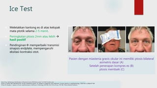 Ice Test
Edsel, B Ing. Opthalmogic Manifestation of Myastenia Gravis.2018.Disitasi pada 7 Juli 2022.Tersedia pada https://emedicine.medscape.com/article/1216417-overview#a1
Fortin E, Cestari DM, Weinberg DH. Ocular myasthenia gravis: an update on diagnosis and treatment. Current opinion in ophthalmology. 2018 Nov 1;29(6):477-84.
O'Hare M, Doughty C. Update on ocular myasthenia gravis. InSeminars in Neurology 2019 Dec (Vol. 39, No. 06, pp. 749-760). Thieme Medical Publishers.
 Meletakkan kantong es di atas kelopak
mata ptotik selama 2-5 menit.
 Peningkatan ptosis 2mm atau lebih 
hasil positif
 Pendinginan memperbaiki transmisi
sinapsis endplate, mempengaruhi
eksitasi-kontraksi otot.
Pasien dengan miastenia gravis okular ini memiliki ptosis bilateral
asimetris dasar (A)
Setelah penerapan kompres es (B)
ptosis membaik (C)
 