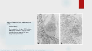 Mikroskop elektron NMJ (diwarnai untuk
AChR).
(A) Individu biasa.
(B) Seorang pasien dengan GMG sedang.
NMJ pada miastenia menunjukkan
defisiensi pewarnaan AChR serta
degenerasi pascasinaps.
O'Hare M, Doughty C. Update on ocular myasthenia gravis. InSeminars in Neurology 2019 Dec (Vol. 39, No. 06, pp. 749-760). Thieme Medical Publishers.
 