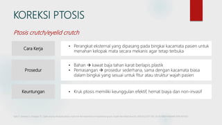KOREKSI PTOSIS
Cara Kerja
• Perangkat eksternal yang dipasang pada bingkai kacamata pasien untuk
menahan kelopak mata secara mekanis agar tetap terbuka
Prosedur
• Bahan  kawat baja tahan karat berlapis plastik
• Pemasangan  prosedur sederhana, sama dengan kacamata biasa
dalam bingkai yang sesuai untuk fitur atau struktur wajah pasien
Keuntungan
Saidi T, Sivarasu S, Douglas TS. Open source modular ptosis crutch for the treatment of myasthenia gravis. Expert Rev Med Devices. 2018;15(2):137-143. doi:10.1080/17434440.2018.1421455
• Kruk ptosis memiliki keunggulan efektif, hemat biaya dan non-invasif
Ptosis crutch/eyelid crutch
 