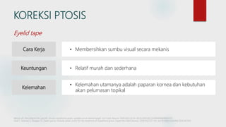 KOREKSI PTOSIS
Cara Kerja • Membersihkan sumbu visual secara mekanis
Keuntungan • Relatif murah dan sederhana
Kelemahan
• Kelemahan utamanya adalah paparan kornea dan kebutuhan
akan pelumasan topikal
Eyelid tape
Melson AT, McClelland CM, Lee MS. Ocular myasthenia gravis: updates on an elusive target. Curr Opin Neurol. 2020;33(1):55-61. doi:10.1097/WCO.0000000000000775
Saidi T, Sivarasu S, Douglas TS. Open source modular ptosis crutch for the treatment of myasthenia gravis. Expert Rev Med Devices. 2018;15(2):137-143. doi:10.1080/17434440.2018.1421455
 