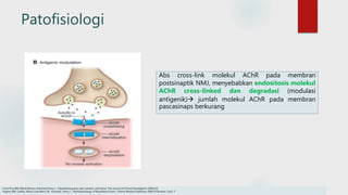 Patofisiologi
Abs cross-link molekul AChR pada membran
postsinaptik NMJ, menyebabkan endositosis molekul
AChR cross-linked dan degradasi (modulasi
antigenik) jumlah molekul AChR pada membran
pascasinaps berkurang
Conti-Fine BM, Milani,Monica ,Kaminski,Henry J. . Myasthenia gravis: past, present, and future. The Journal of Clinical Investigation 2006;116
Hughes BW, Casillas, Maria Luisa Moro De , Kaminski, Henry J.,. Pathophysiology of Myasthenia Gravis. Thieme Medical Publishers 2004;24 Number 1:p21-7
 