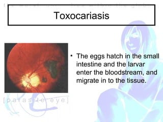 Roundworm In Eye NW2005 Ocular parasites | PPT