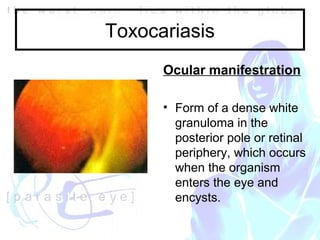 Roundworm In Eye NW2005 Ocular parasites | PPT