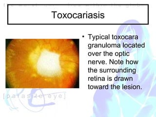 Roundworm In Eye NW2005 Ocular parasites | PPT