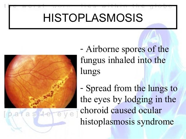 overview of ocular histoplasmosis syndrome ohs Overview – ocular histoplasmosis syndrome histoplasmosis is caused by a fungus commonly found in the dust and soil of the mississippi-ohio river valley region. overview of ocular histoplasmosis syndrome ohs Overview – ocular histoplasmosis syndrome histoplasmosis is caused by a fungus commonly found in the dust and soil of the mississippi-ohio river valley region.