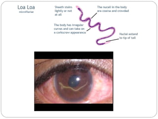 Roundworm In Eye Ocular parasitic infection | PPT